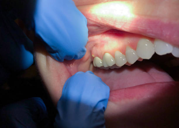 Best Chipped Tooth Repair Near Me  in Lighthouse Point, FL